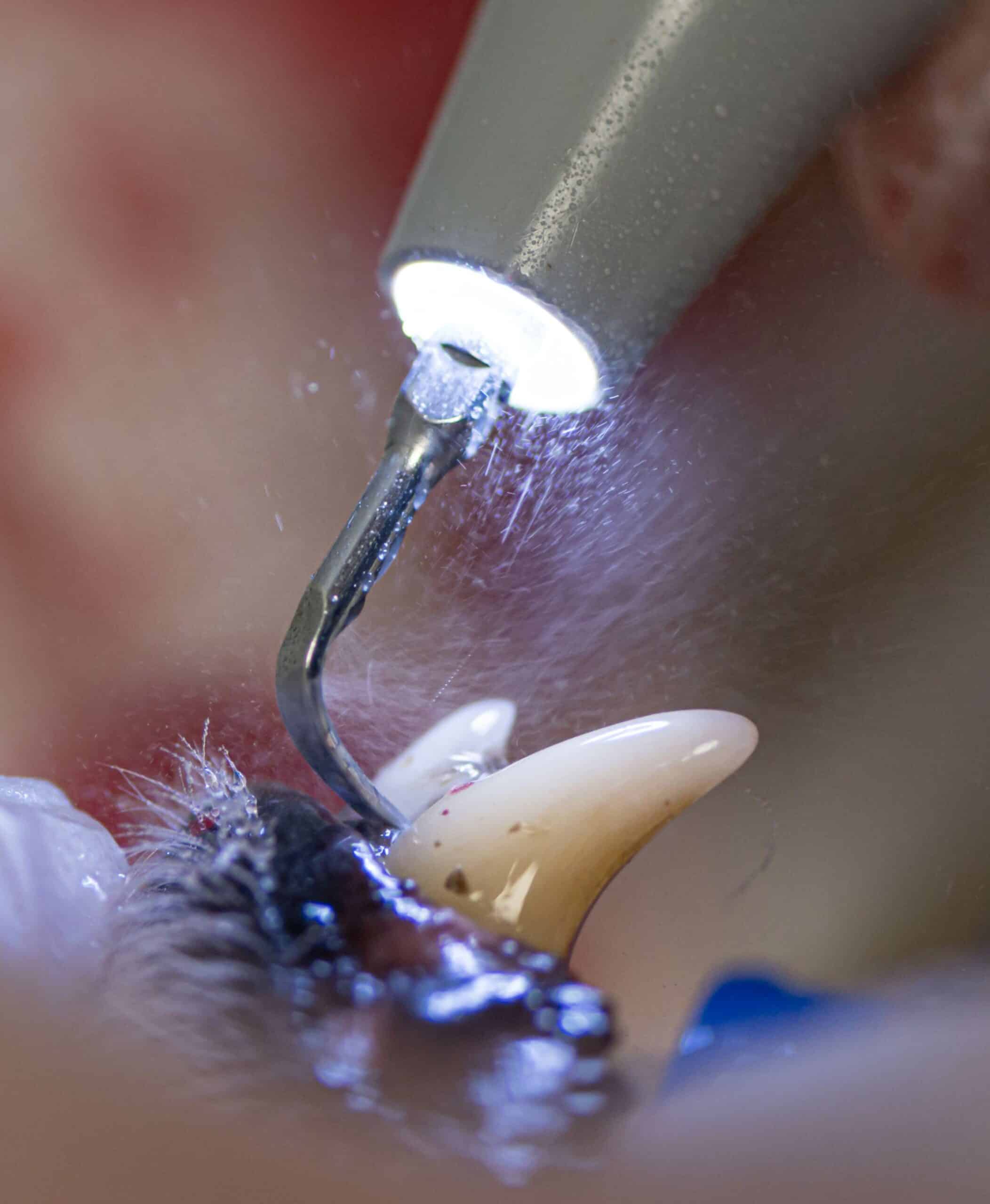 Professional Dental Cleanings